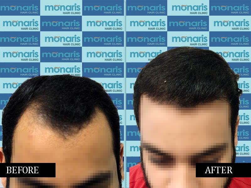 After Before 1 - Hair Transplant Result by Dr.Arihant surana at Monaris Hair Clinic
