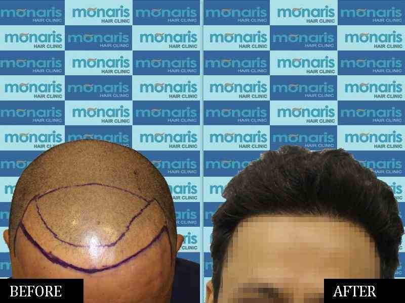 After Before 4 - Hair Transplant Result by Dr.Arihant surana at Monaris Hair Clinic
